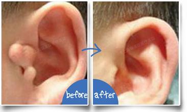 附耳切除术会不会对耳朵有什么危害呢