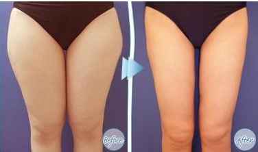 做腿部吸脂瘦腿后还能剧烈运动吗