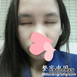 【真人案例】上海百达丽医疗美容门诊部邵玉芳医生割双眼皮案例：全切双眼皮+开内眼角4"