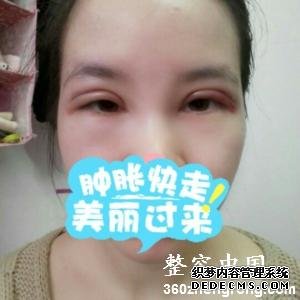 【真人案例】上海百达丽医疗美容门诊部邵玉芳医生割双眼皮案例：全切双眼皮+开内眼角"