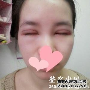 【真人案例】上海百达丽医疗美容门诊部邵玉芳医生割双眼皮案例：全切双眼皮+开内眼角"