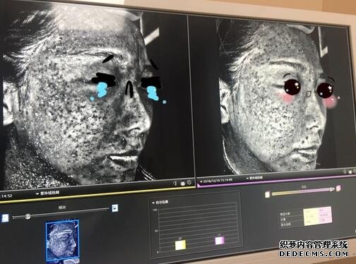 做完光子嫩肤恢复图片 效果满满