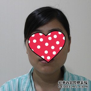 【真人案例】上海华美医疗美容医院李志海医生磨骨瘦脸案例：下颌角+颧骨整形"