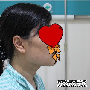 【真人案例】上海华美医疗美容医院李志海医生磨骨瘦脸案例：下颌角+颧骨整形2"