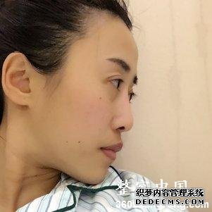 【真人案例】北京焕誉医疗美容门诊部王征医生丰额头案例：自体脂肪填充部（额头+太阳穴+泪沟+法令纹+面颊）3"