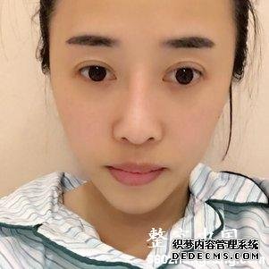 【真人案例】北京焕誉医疗美容门诊部王征医生丰额头案例：自体脂肪填充部（额头+太阳穴+泪沟+法令纹+面颊）21