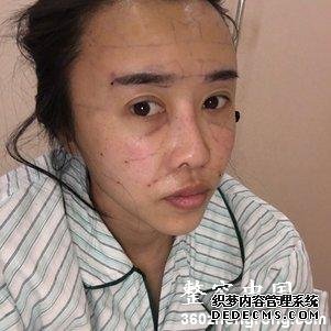 【真人案例】北京焕誉医疗美容门诊部王征医生丰额头案例：自体脂肪填充部（额头+太阳穴+泪沟+法令纹+面颊）10