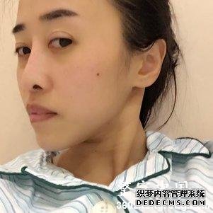 【真人案例】北京焕誉医疗美容门诊部王征医生丰额头案例：自体脂肪填充部（额头+太阳穴+泪沟+法令纹+面颊）2"