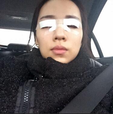 切开双眼皮恢复过程分享 杭州东方做双眼皮2个月