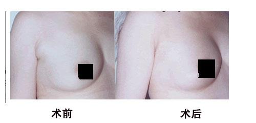 北京做副乳切除手术一般要多少钱